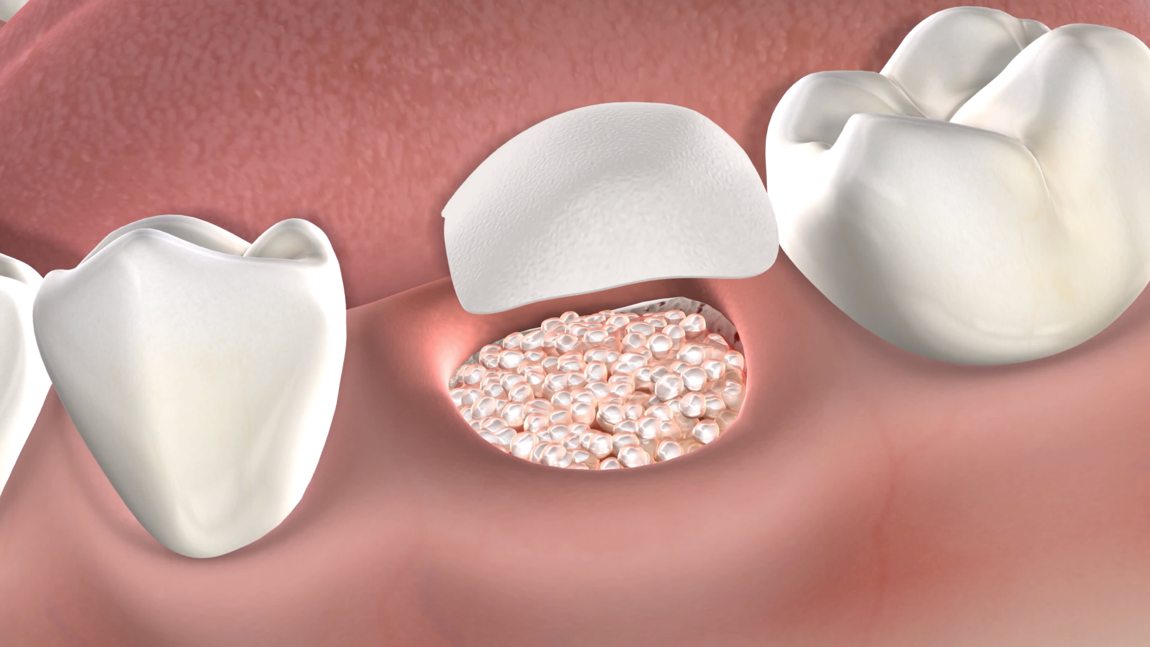 Illustration of bone graft