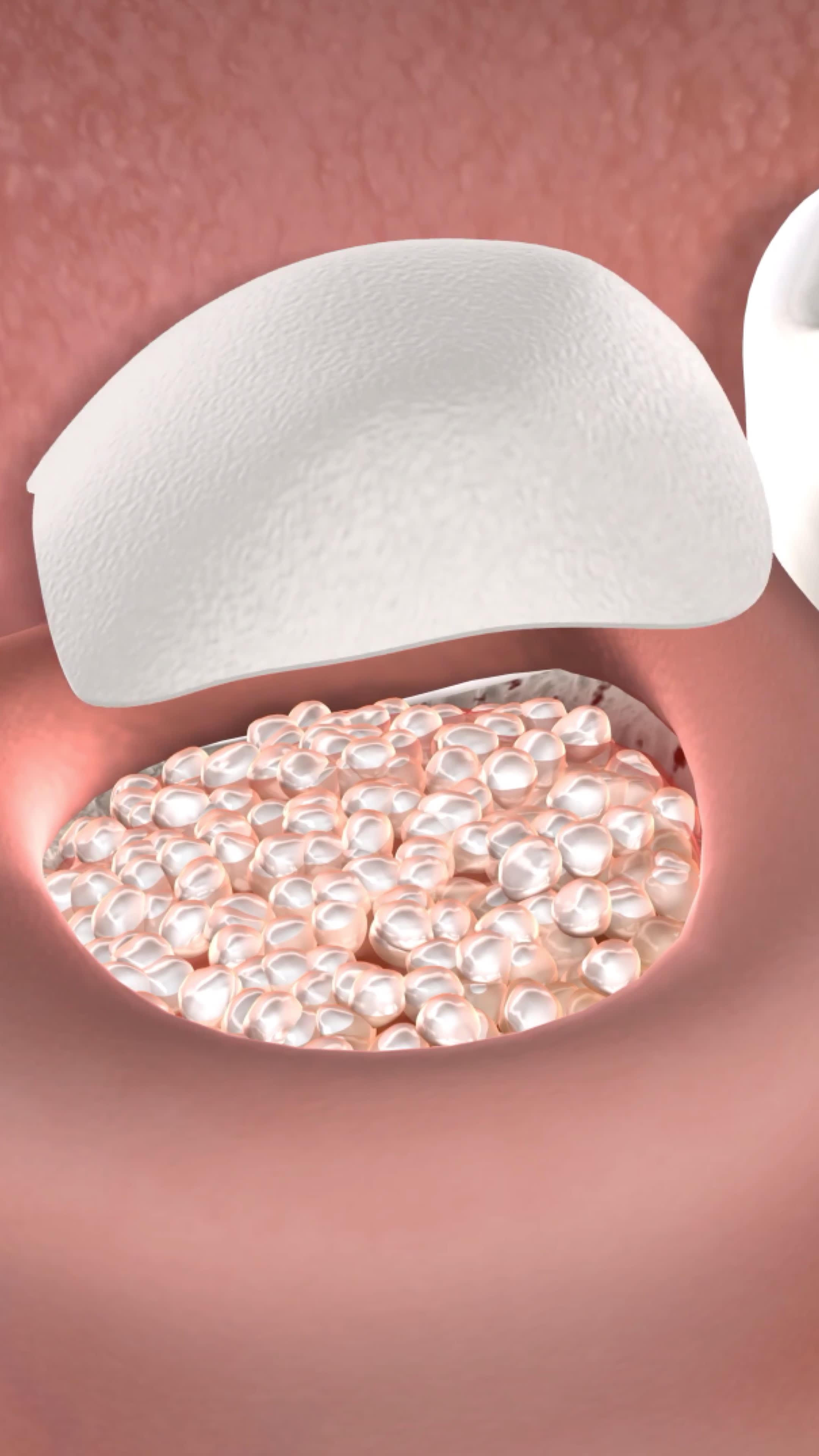 Illustration of bone graft