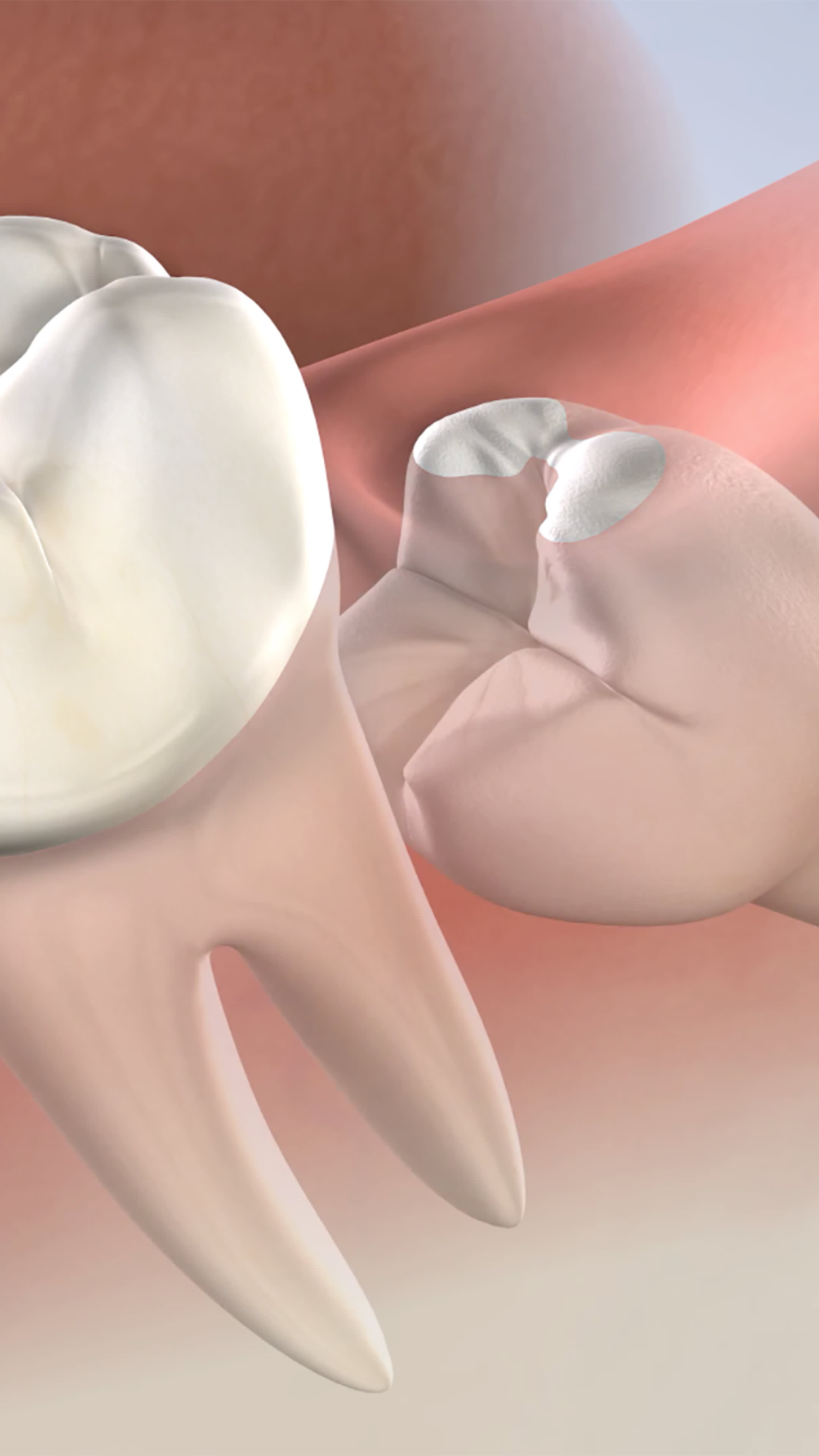 Illustration of an impacted wisdom tooth